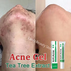 Salicylic Acid Acne Treatment Face Cream Repair Pimple Spots Deep Cleaning Pore Anti-acne Scar Oil Control