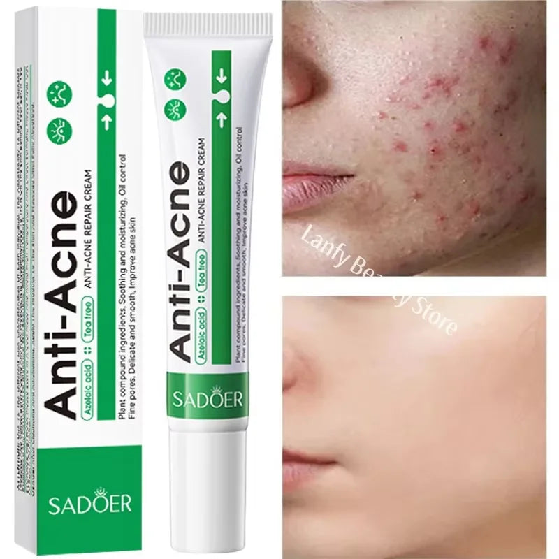 Salicylic Acid Acne Treatment Face Cream Repair Pimple Spots Deep Cleaning Pore Anti-acne Scar Oil Control